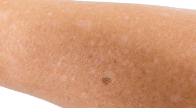 أسباب البقع البيضاء في الجسم: دليل شامل للتشخيص والعلاج الفعال