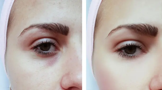 نقط حمراء تحت العين: الأسباب، الأعراض، وطرق العلاج الفعالة