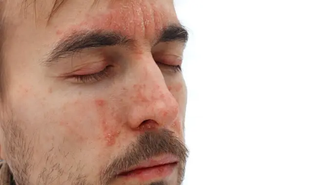 ما هو علاج الأكزيما في الوجه؟ دليلك الشامل لبشرة هادئة ونضرة