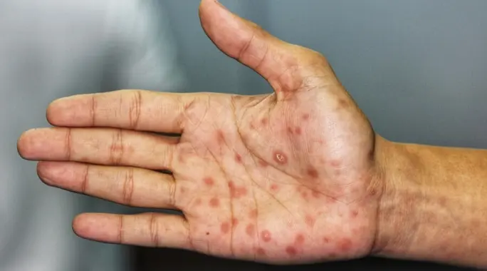 كيف ينتقل مرض الزهري؟ فهم طرق العدوى والوقاية منه