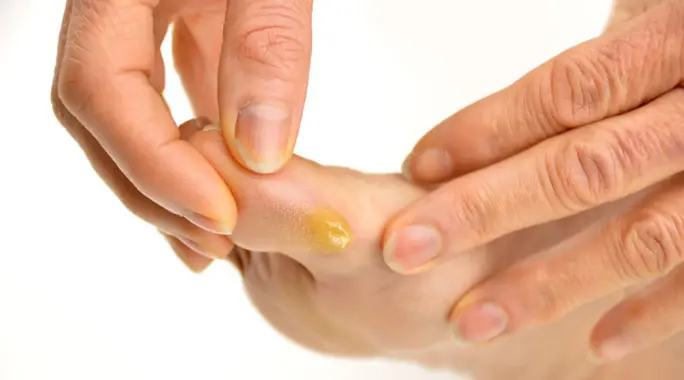 الجلد السميك في القدم: دليل شامل للتخلص منه وعلاجه بفعالية