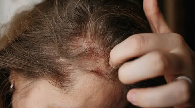هل الثعلبة تسبب حكة؟ اكتشف الأسباب، الأعراض الشائعة، وطرق العلاج