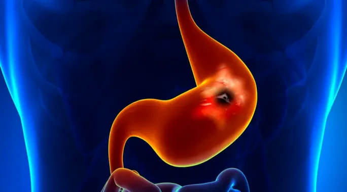 قرحة المعدة: هل هي خطيرة حقًا؟ دليل شامل للمخاطر والوقاية