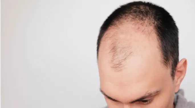 الثعلبة الكلية: دليل شامل لأسبابها، تشخيصها، وخيارات العلاج