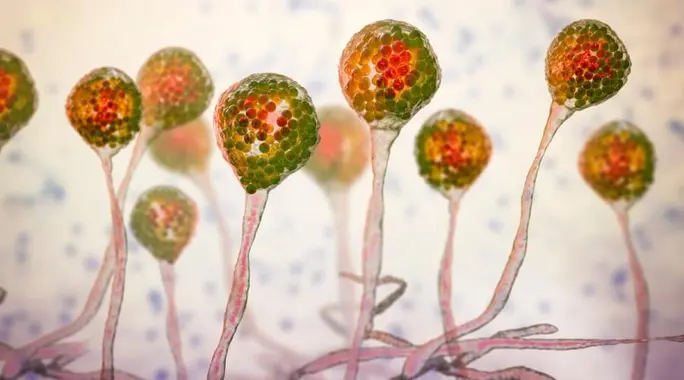 العفن الأسود (Mucormycosis): دليلك الشامل لفهم عدوى الفطريات الخطيرة