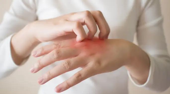 سبب احمرار اليدين: كل ما تحتاج معرفته عن الأسباب والعلاج
