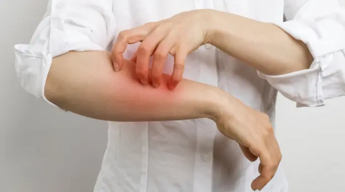علاج الجرب نهائيًا: دليلك الشامل للتخلص من سوس الحكة والأعراض المزعجة
