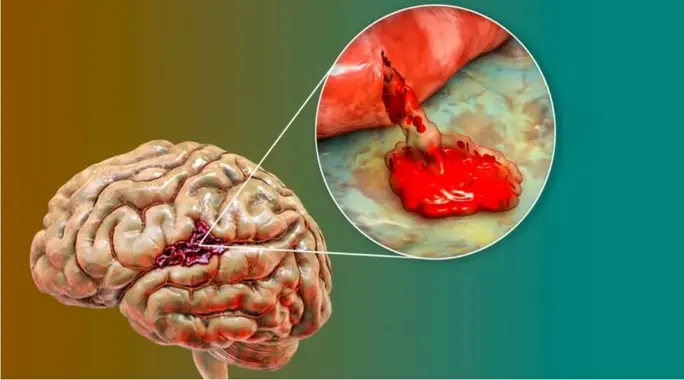 هل نزيف الدماغ خطير حقًا؟ دليل شامل للأعراض والأسباب والعلاج