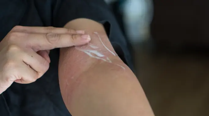 مدة علاج الجرب: دليل شامل للتعافي من العدوى المزعجة