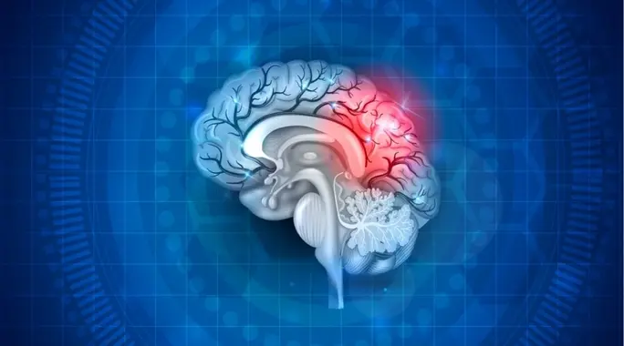 علاج الجلطة الدماغية: دليل شامل لأحدث طرق الإنقاذ والتعافي