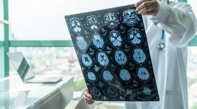 الجلطة الدماغية الخفيفة (TIA): علامات تحذيرية لا تتجاهلها ودليلك الشامل للوقاية والعلاج