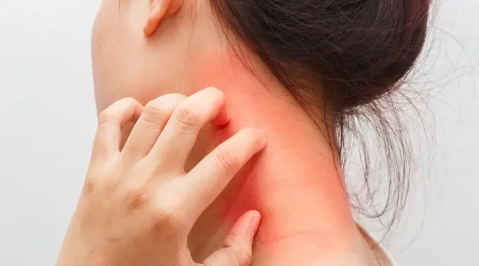 اكتشف أفضل طرق علاج حساسية الرقبة: حلول منزلية وطبية فعالة