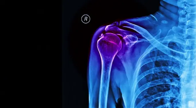 تكلس الكتف: دليلك الشامل لفك آلام الكتف وتخفيف التكلسات