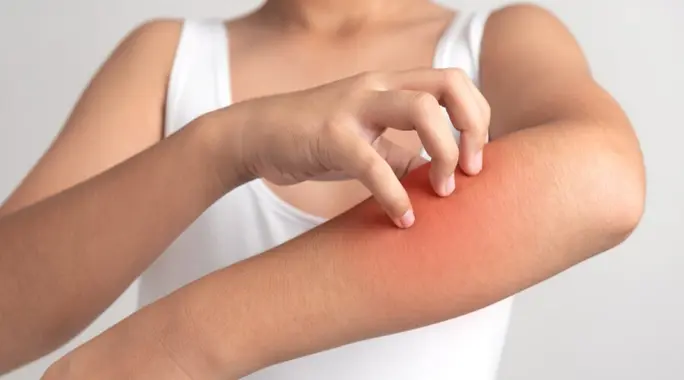 Scabies vs. Allergy: How to Tell the Difference and What to Do
