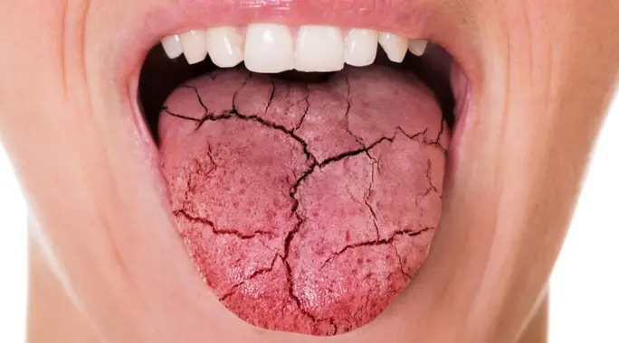 وداعًا لجفاف الفم: دليلك الشامل لـ علاج جفاف الفم وأسبابه الشائعة