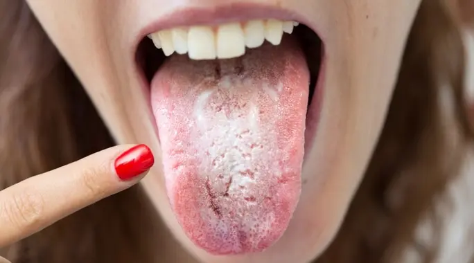 لماذا تظهر طبقة بيضاء على لسانك مع رائحة كريهة؟ الأسباب والعلاج الفعال