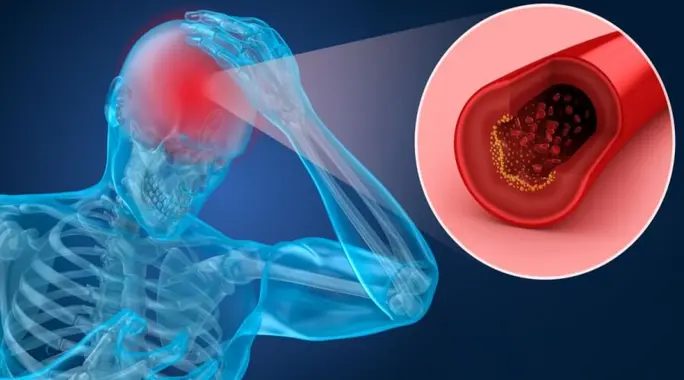 لا وقت للانتظار: أحدث طرق علاج تخثر الدم في الدماغ والتشخيص
