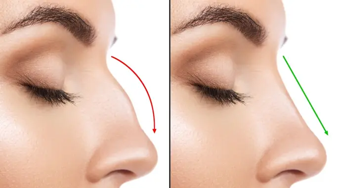 عملية تجميل الأنف: دليل شامل لتغيير شكل الأنف ونتائجها