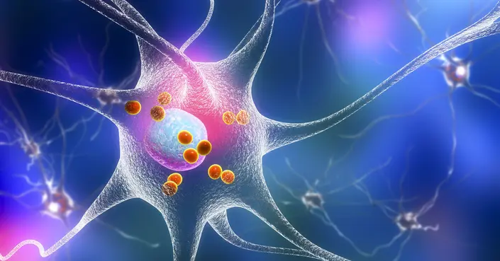 خرف أجسام ليوي: دليل شامل لفهم الأعراض، الأسباب، والتعامل معه