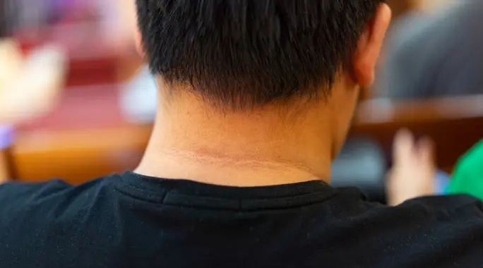 اكتشفها مبكرًا: أعراض مقاومة الإنسولين على الجلد ودلالاتها الصحية