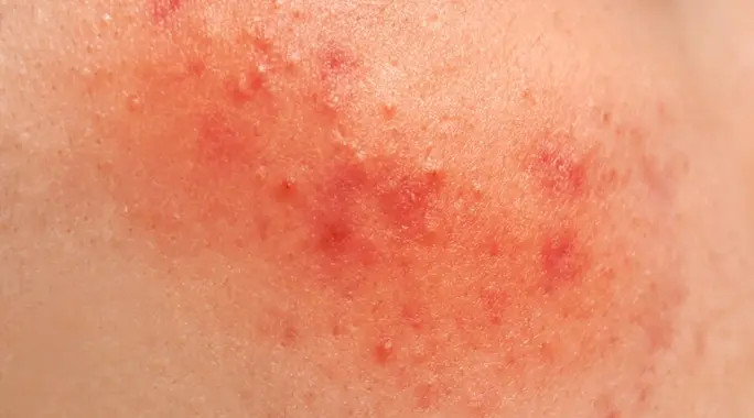 دليل شامل لـ علاج تهيج الجلد من المبيدات: خطوات فورية للوقاية والعلاج