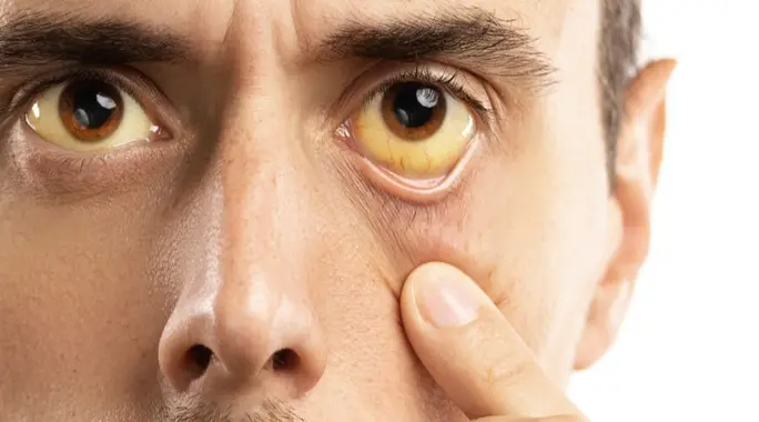 أعراض الكبد على الوجه: علامات تحذيرية يجب أن تعرفها