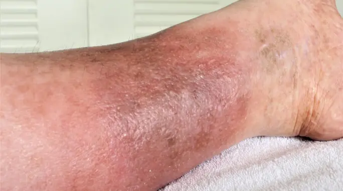 مرض الحمرة لمرضى السكر: دليل شامل للوقاية والعلاج الفعال