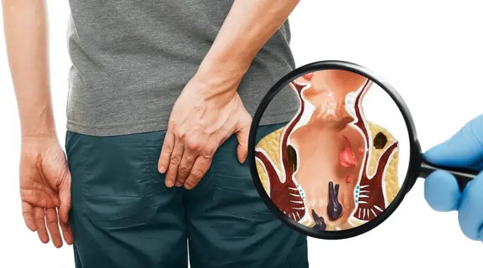 أعراض فشل عملية البواسير: علامات لا يجب تجاهلها بعد الجراحة