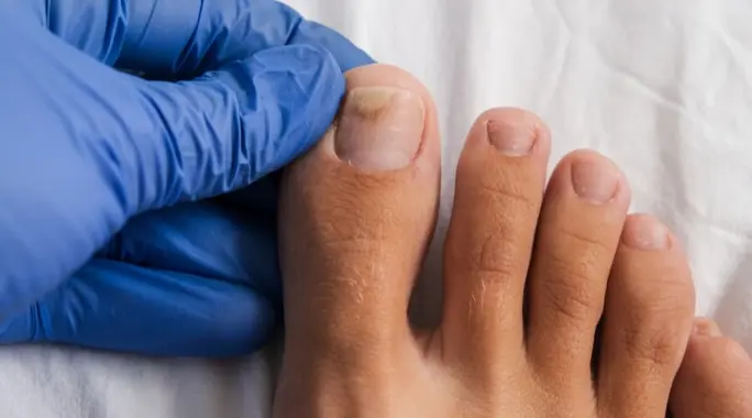 علاج انفصال الظفر عن اللحم: دليلك الشامل للأسباب، العلاج، والوقاية