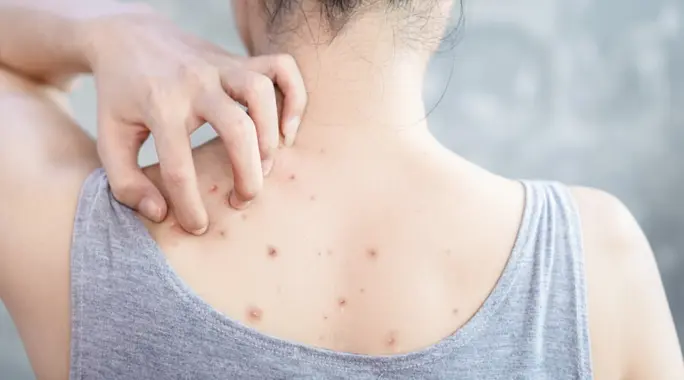 حبوب الظهر عند النساء: دليلك الشامل للتخلص منها