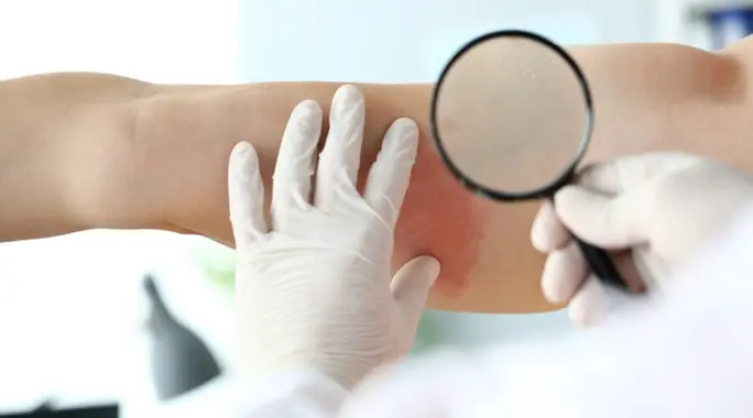 اكتشف أسرع طريقة لعلاج الحزام الناري والتخفيف من أعراضه