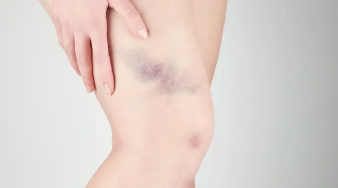 أسباب ظهور بقع زرقاء على الفخذ: دليل شامل لفهم الكدمات وعواملها
