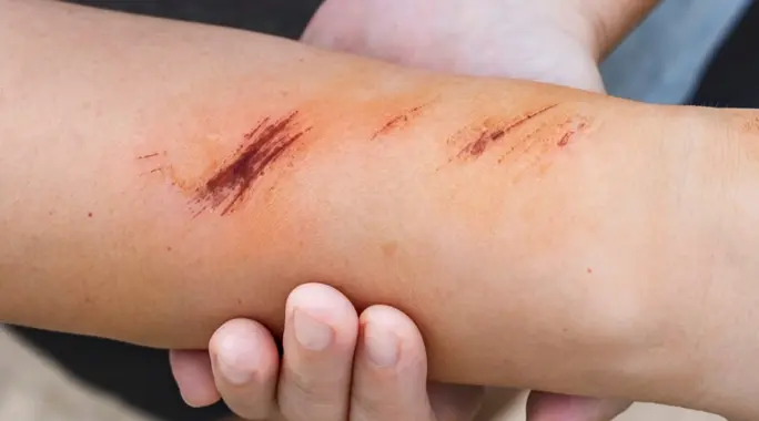 أنواع جروح السكري: دليلك الشامل للوقاية والعلاج الفعال