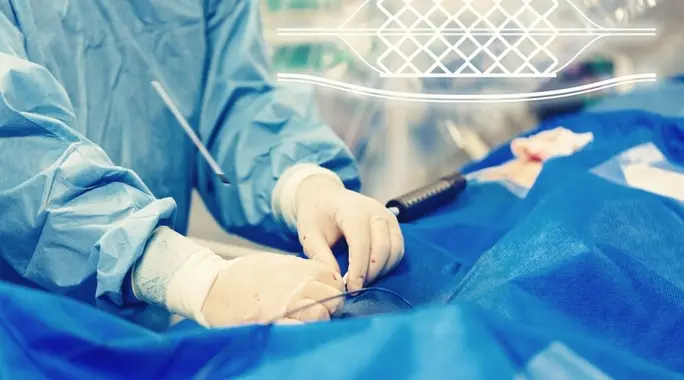 عملية شبكية القلب: دليلك الشامل لاستعادة صحة قلبك