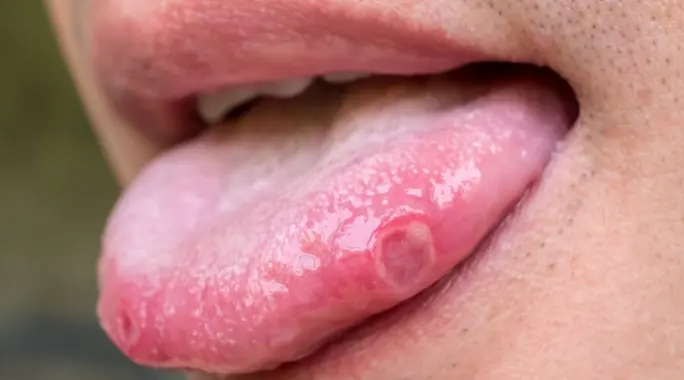 لماذا تظهر حبة بيضاء مؤلمة في طرف اللسان؟ الأسباب والعلاج الفعال