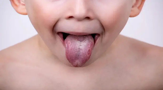 ماذا تعني الحبوب الحمراء على لسان طفلك؟ دليل الوالدين الشامل