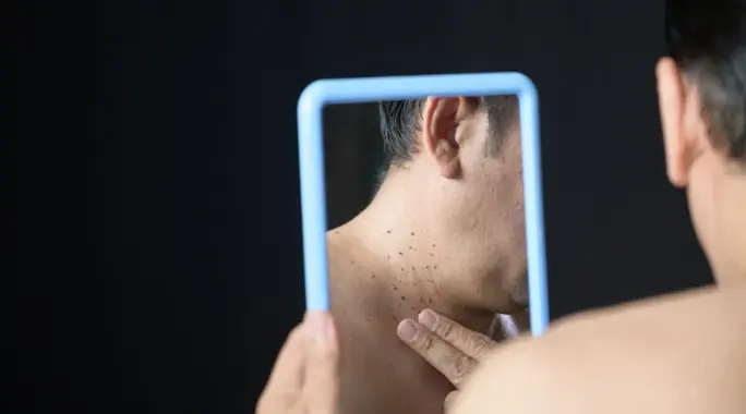 هل الزوائد الجلدية معدية؟ اكتشف الحقيقة الكاملة وما يجب أن تعرفه