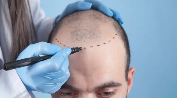 هل زراعة الشعر ناجحة حقًا؟ دليلك الشامل لنتائج مضمونة!