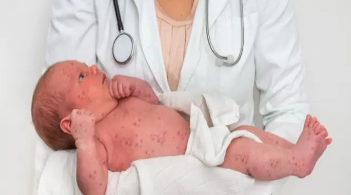 الحصبة: متى تصبح خطيرة حقًا؟ وماذا تحتاج أن تعرف؟