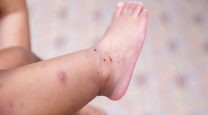 Effective Strategies: How to Treat Hand, Foot, and Mouth Disease at Home