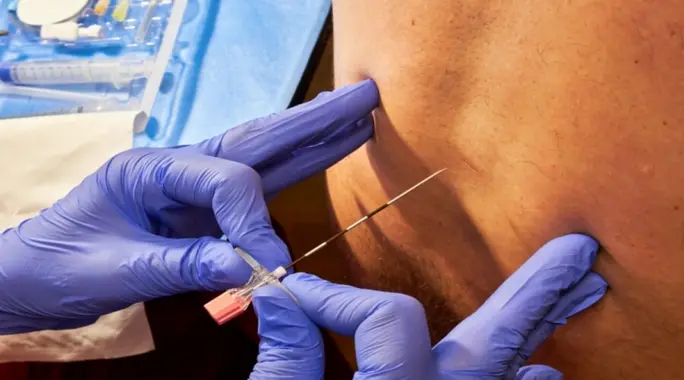 إبرة الظهر للديسك: دليلك الشامل لتخفيف آلام الانزلاق الغضروفي