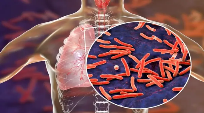 أنواع مرض السل: دليل شامل لفهم الفروقات والأعراض الرئيسية