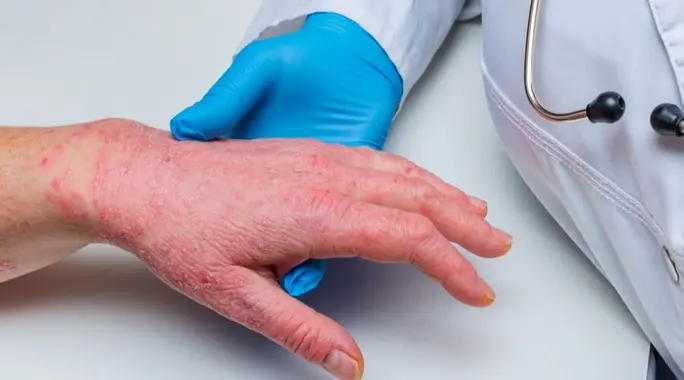 علاج الطفح الجلدي بسبب الدواء: دليل شامل للتعافي والوقاية