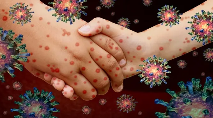 مرض الفم واليد والقدم: هل هو معدي؟ دليلك الشامل للوقاية والعلاج