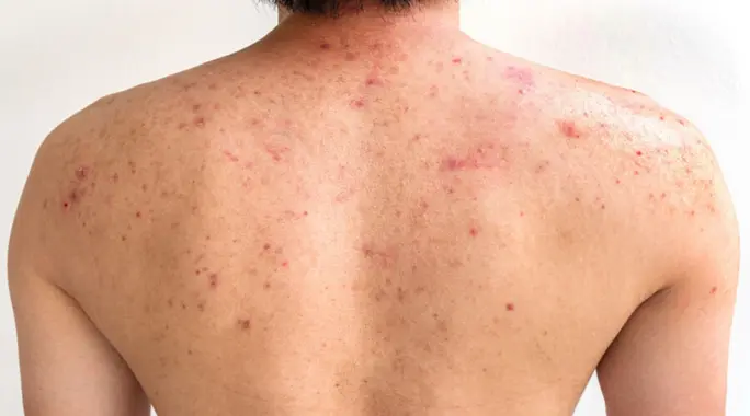 أسباب حبوب الظهر: دليل شامل للتخلص من بثور الظهر المزعجة