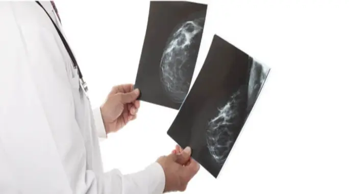 Breast Calcifications: When Is a Biopsy Truly Necessary?