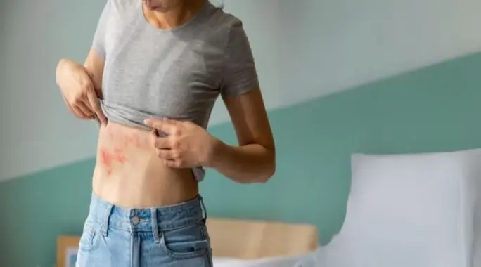 الحزام الناري: دليل شامل لفهم المرض، الأعراض، وطرق الوقاية