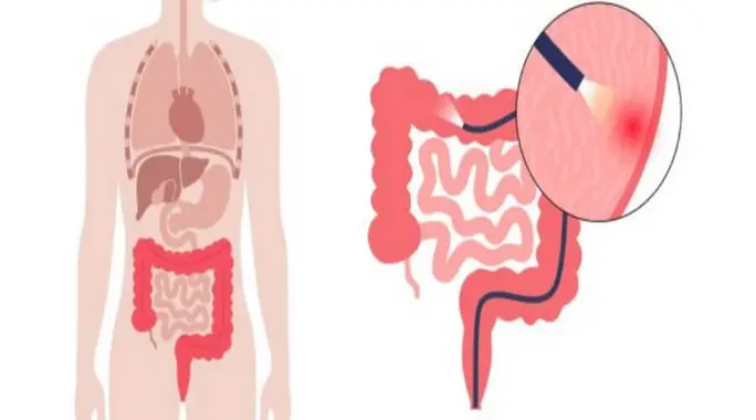 Turning 45? Here&#8217;s Why a Colonoscopy Becomes Essential for Your Health