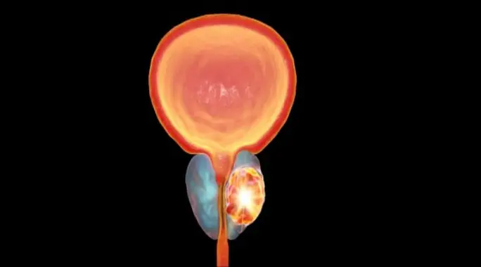 الآثار الجانبية للعلاج الإشعاعي لسرطان البروستاتا: فهم العلاقة بين المضاعفات المبكرة والمتأخرة