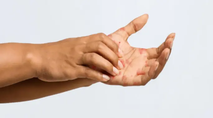 Understanding Eczema: Causes, Types, and Triggers You Need to Know